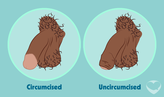 circumcised versus not circumcised