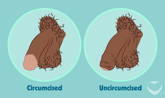 circumcised uncircumcised penis