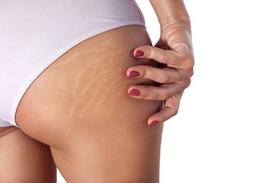  Let’s talk about stretch marks