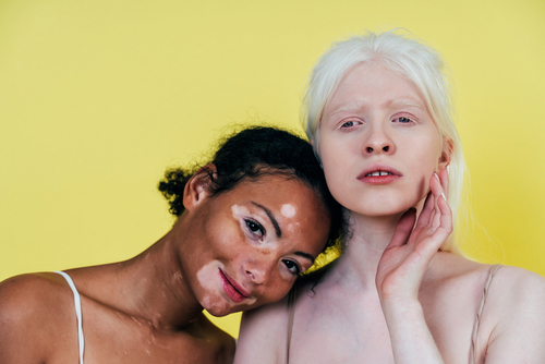 Group of multiethnic women with different kind of skin posing together in studio. Concept about body positivity and self acceptance